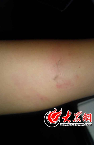 李先生的左手有淤青和擦伤痕迹