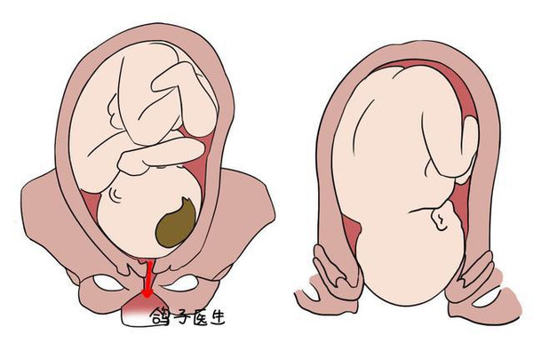 顺产和剖腹产到底哪个更痛?