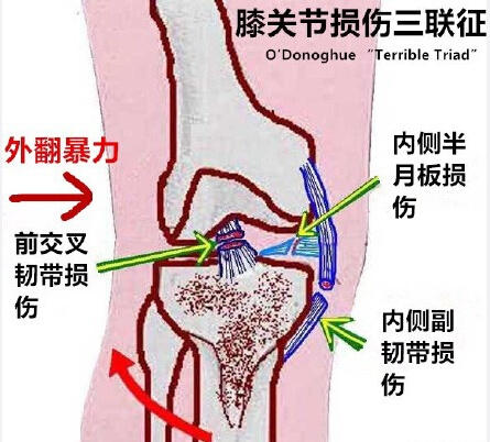 膝关节损伤三联症