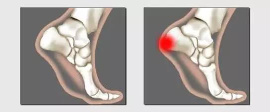 脚后跟疼是什么原因怎么治疗