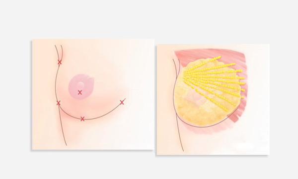 产后女人胸部缩水下垂能做自体脂肪隆胸吗