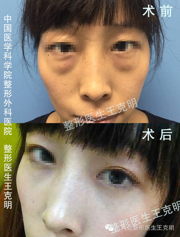 最能灭老相的去眼袋手术详图