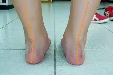 外翻足(supination,中性足(neutral)和内翻足(pronation.