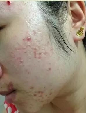 脸上长痤疮图片_脸上长痤疮怎么办