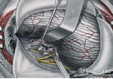 神经外科keyhole手术入路——乙状窦后入路