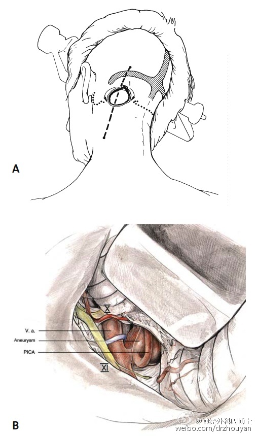 yasargil旁正中小脑上入路处理pica小动脉瘤,发表于其1984年出版的
