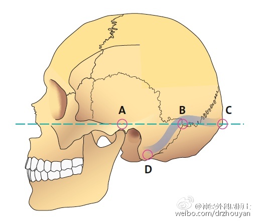 注意:乳突上嵴(a),星点(b),枕外隆突(c)和乳突(d).