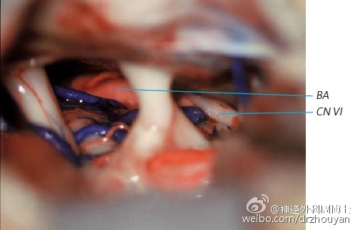 神经外科keyhole手术入路乙状窦后入路