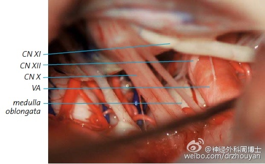 step11 现在将注意力集中在椎动脉及其表面的舌下神经纤维.