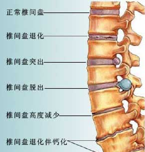 健骨1号如何治愈腰椎间盘突出症状-搜狐