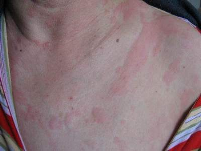 从慢性荨麻疹案例说到易反复发作皮肤病