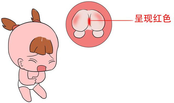 体内有火,宝宝的肛门正常时是粉红色,肠内有热时,就会呈现红色,颜色越