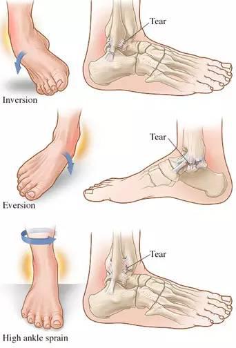 2013-9-19 踝关节扭伤 contusion of sprain of ankle