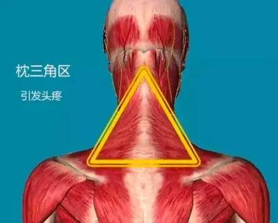 no2:引发头痛的枕三角