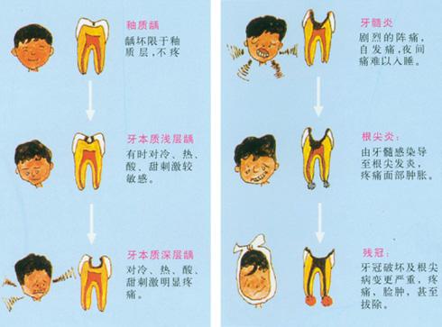 那么,什么是三度龋齿呢?    温凊定省  怎么才能防治蛀牙?