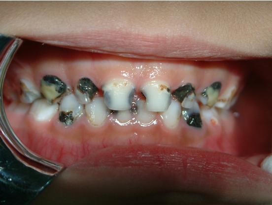 奶瓶龋损害牙齿经常在乳前牙邻面和唇面,有时也会出现在乳磨牙牙合面