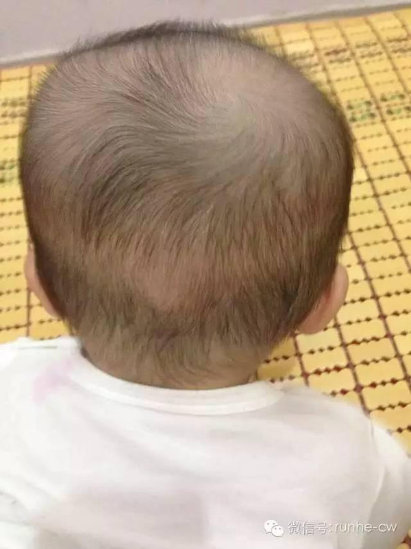2岁宝宝头颅奇怪发生变形,90%家长不会注意这
