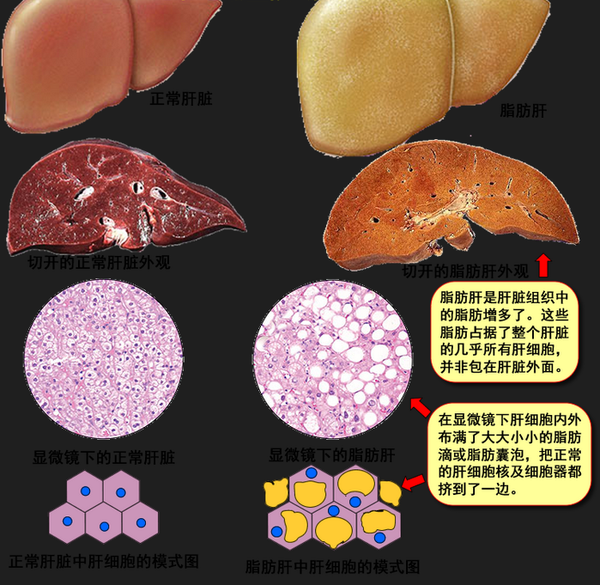 "肝病专家"讲解:脂肪肝的脂肪"长"在哪儿