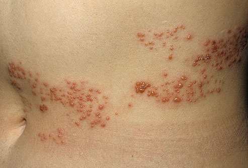 带状疱疹常发于躯干和臀部,但是也可在任何部位出现.