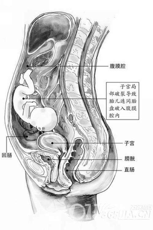 什么是腹腔妊娠?腹腔妊娠会有什么危害?