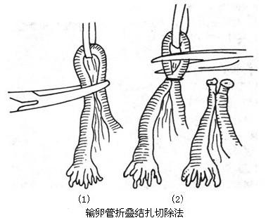 女性输卵管结扎可能出现的后遗症