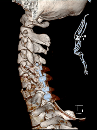 脊柱胸腰段爆裂性骨折术后椎弓根螺钉断裂原因分析及其对策