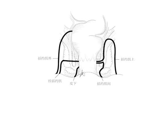 克罗恩病肛周病变-肛瘘肛周脓肿篇