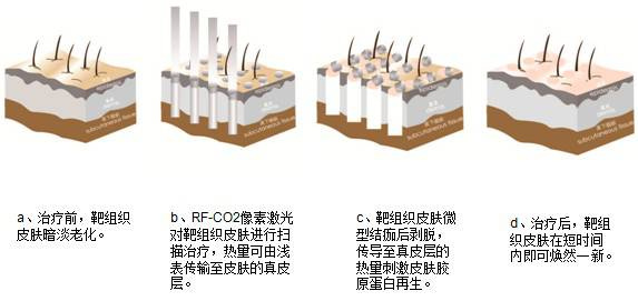 悦美APP医美名医录:深度解析激光去痘疤