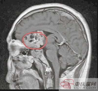 头部核磁忘了脱内衣_头部核磁(2)