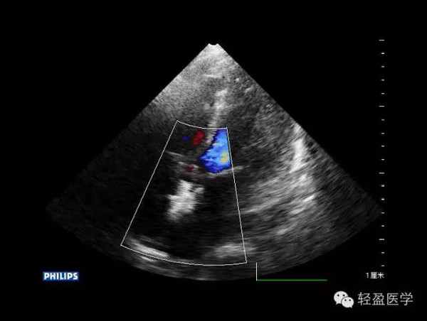 心脏彩超图像:(封堵伞释放后) 术后