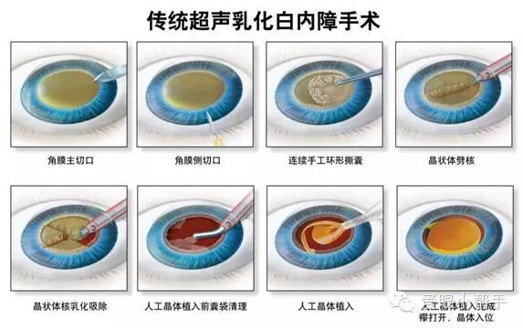 老年人退行性心脏瓣膜病例超声心动图分析31