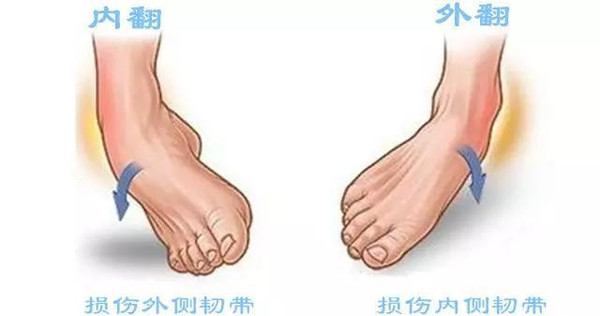 比较的动作有下楼梯,下山,起跳后落地等活动; 踝关节周围则出现
