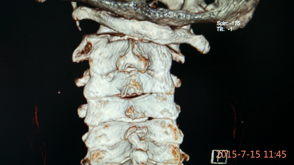 枢椎齿状突骨折枢椎前滑脱