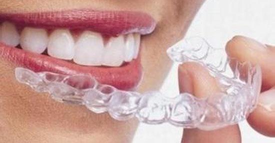 为什么众多女星花大价钱也要做隐形牙套矫正?