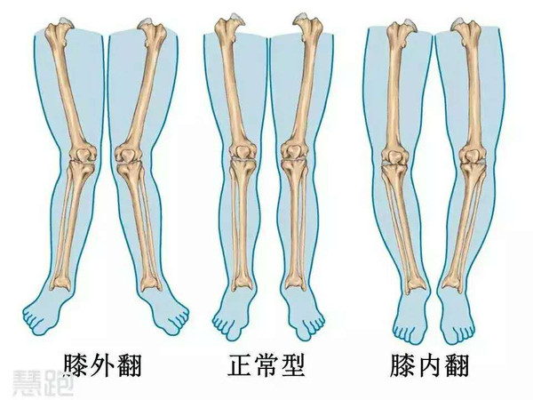 不跑就出局:o/x型腿真的不适合跑步吗?