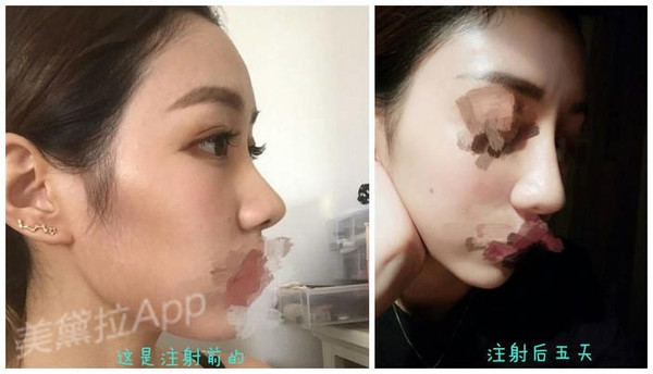 悄悄变美好吗玻尿酸填充山根