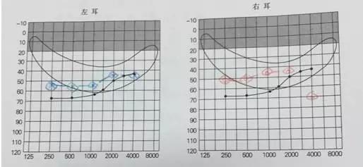 5岁时候复查,配合极佳,做了些调整.声阻抗:双耳均为a型.
