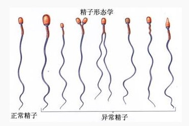 精子畸形还能做试管婴儿吗？