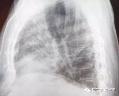 医学影像APP病例分享:劳力性呼吸困难
