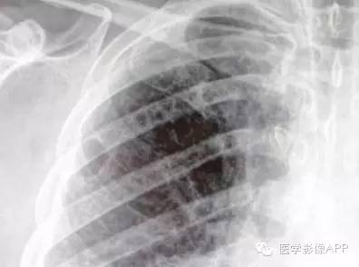 医学影像APP病例分享:劳力性呼吸困难
