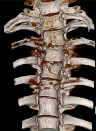 胸4爆裂性骨折,椎体滑脱