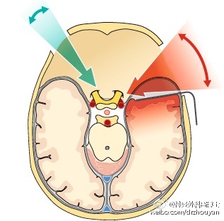 神经外科护理不良事件的因素分析及对策