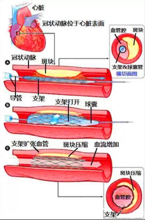 聊聊倍受争议的心脏支架和搭桥!你怎么看呢?_搜狐健康