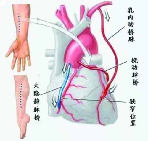 聊聊倍受争议的心脏支架和搭桥!你怎么看呢?