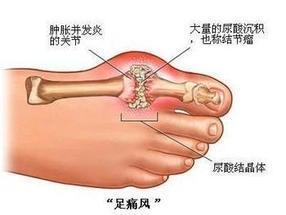 沉积于关节内,关节周围,皮下,肾脏等部位,引发急,慢性炎症和组织损伤