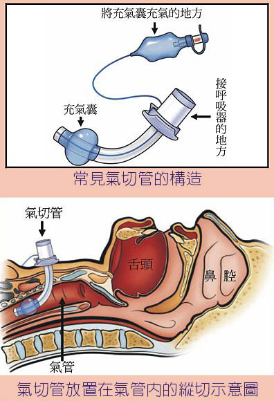 老年患者长期鼻饲引发误吸的原因及护理对策