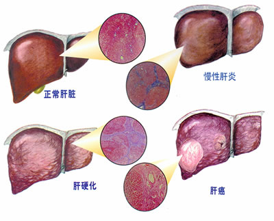 如何利用fib4指数评估肝纤维化