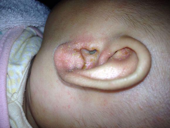 宝宝耳朵进水怎样处理?避免耳膜炎!