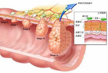 内镜下切除结直肠大息肉的护理配合