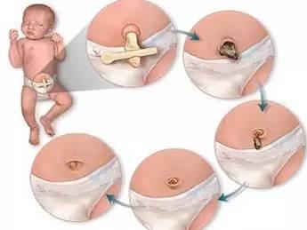 新生儿肚脐要如何护理 6个常见错误不要犯!